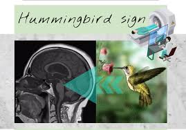 Hummingbird brain pattern in MRI of the Brain = PSP